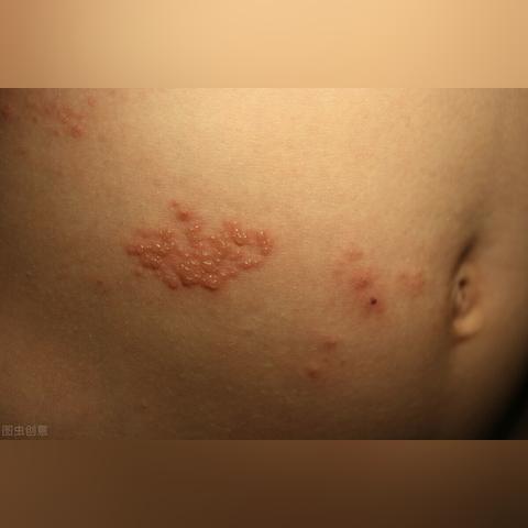 疱疹详解，症状图片全解析，表象特征与深度了解
